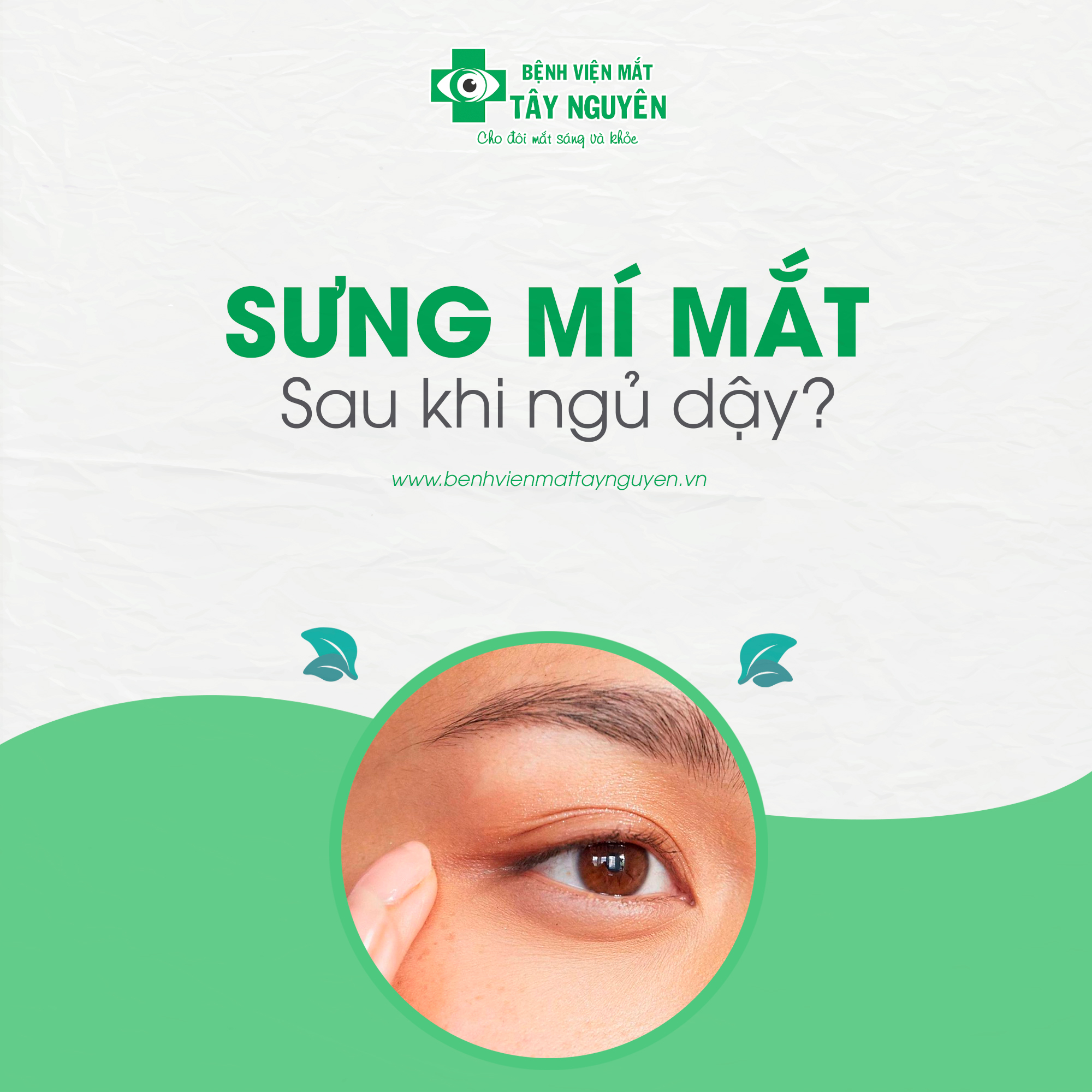 Hiện Tượng Sưng Mắt Và Một Số Cách Làm Giảm Tại Nhà